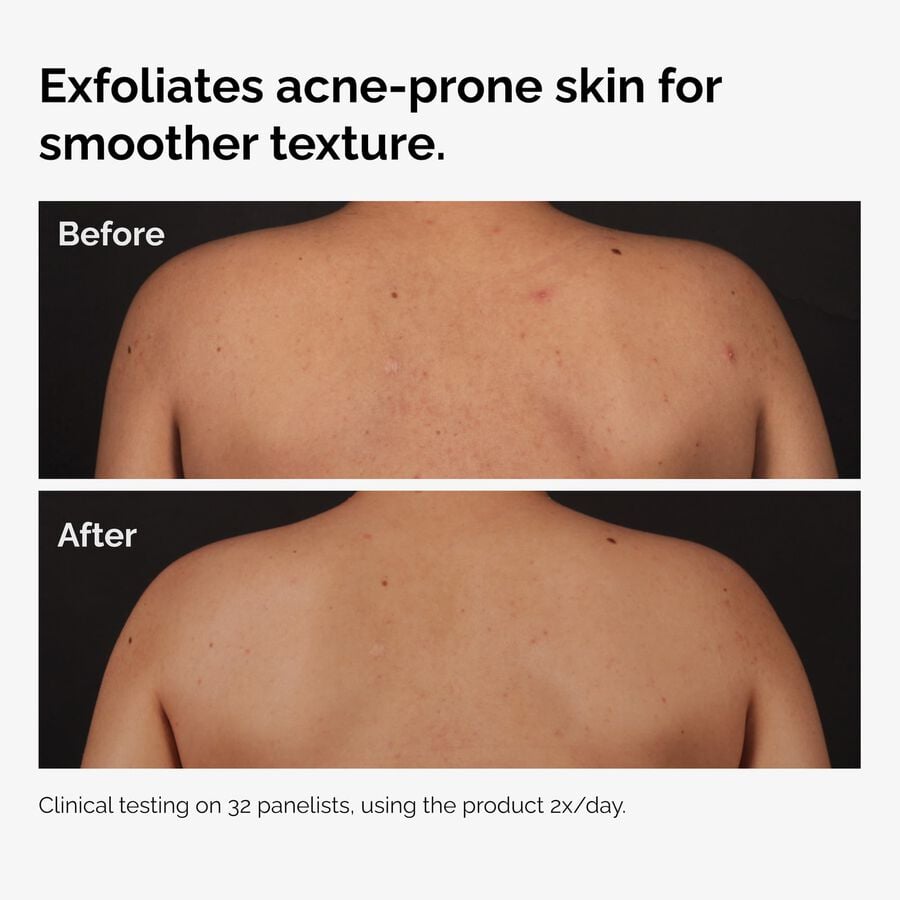 the-body-care-collection-m0 ord-salicylic-acid-body-serum-before-after-graphic-NA.jpg