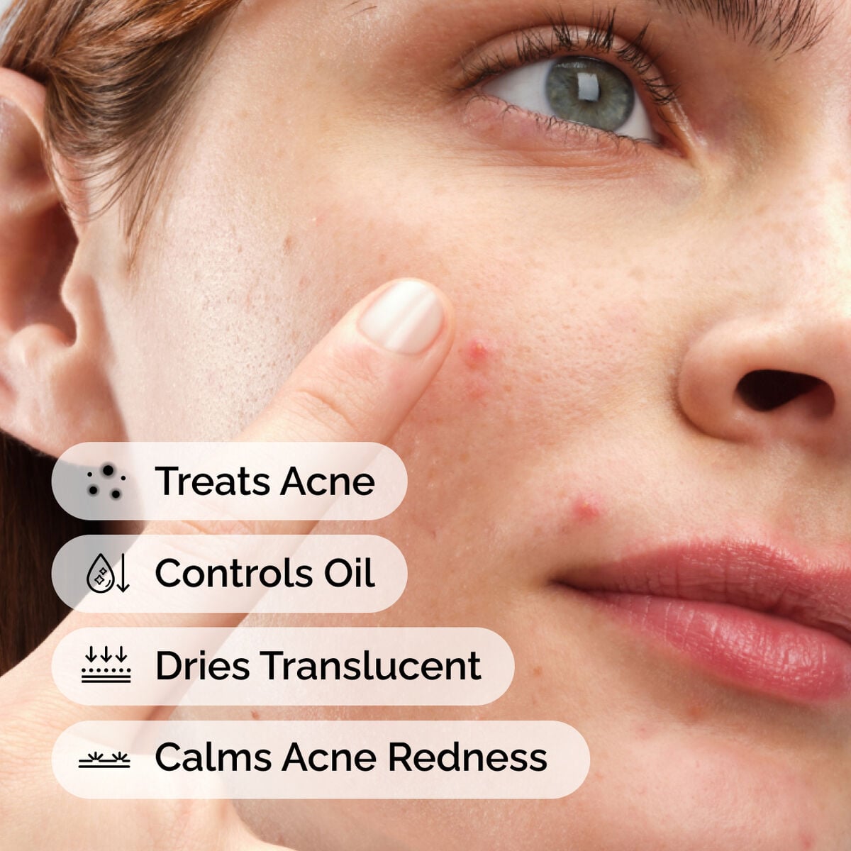 sulfur-10-powder-to-cream-concentrate-q1 ord-sulfur-10pct-powder-to-cream-concentrate-model-application-with-benefits-acne.jpg